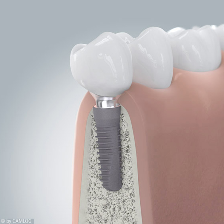 Zahnimplantat in Hannover: Implantate für feste Zähne in Herrenhausen